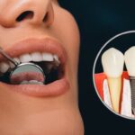 Smile Perfection Awaits Brilliantly Using Dental Implants in Dubai 20 titanium dental implants