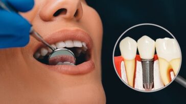 titanium dental implants