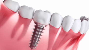 Is A Dental Implant For Teeth Good Or Bad