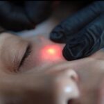 Lift and contour your facial outline using Endolift in Dubai 20 Endolift 735