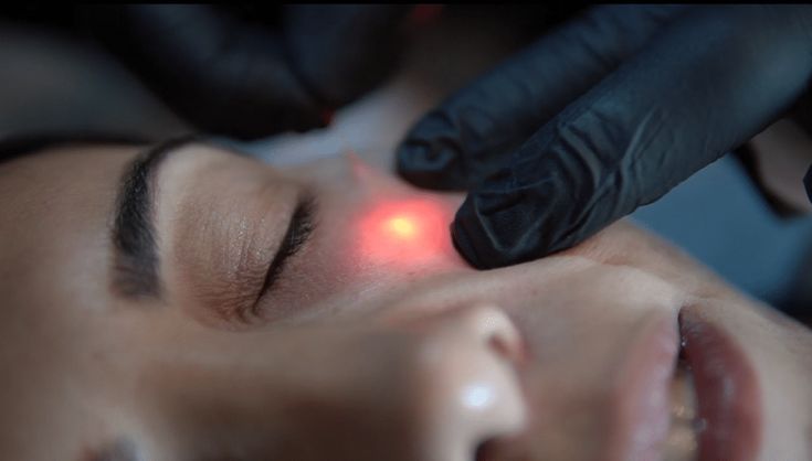 Lift and contour your facial outline using Endolift in Dubai 1 Endolift 735